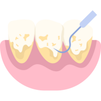 Icon showing plaque and calculus being scaled off of teeth.