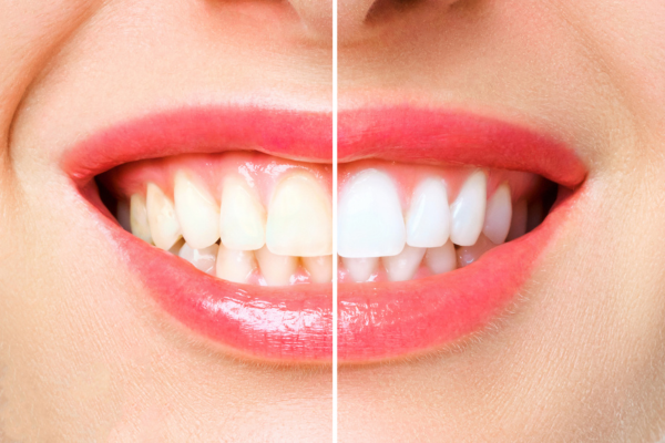 Before and after of tooth whitening at Dr. Haselhorst's Naperville dental office.
